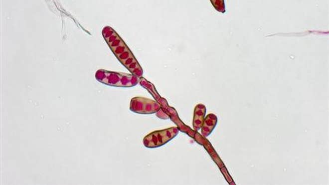 meningitis outbreak fungi.jpg